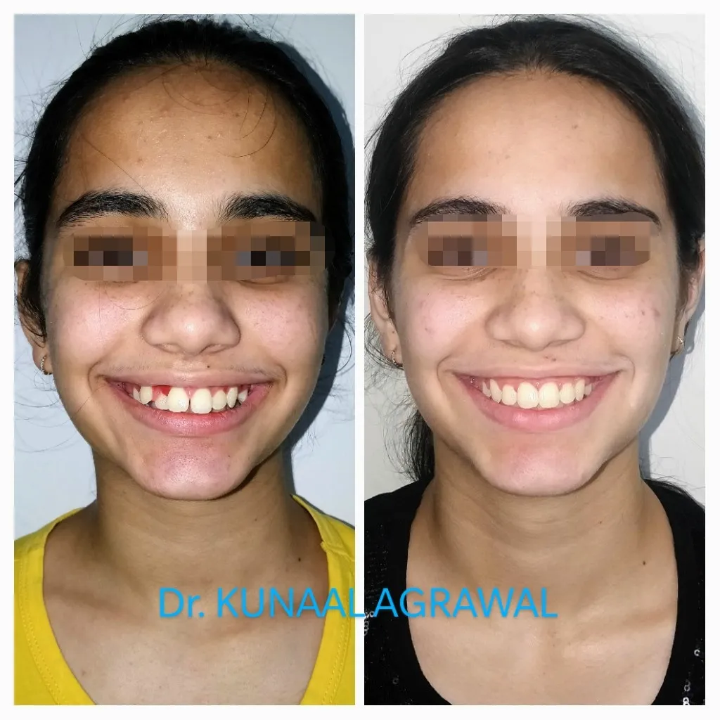 braces before and after bhopal 8